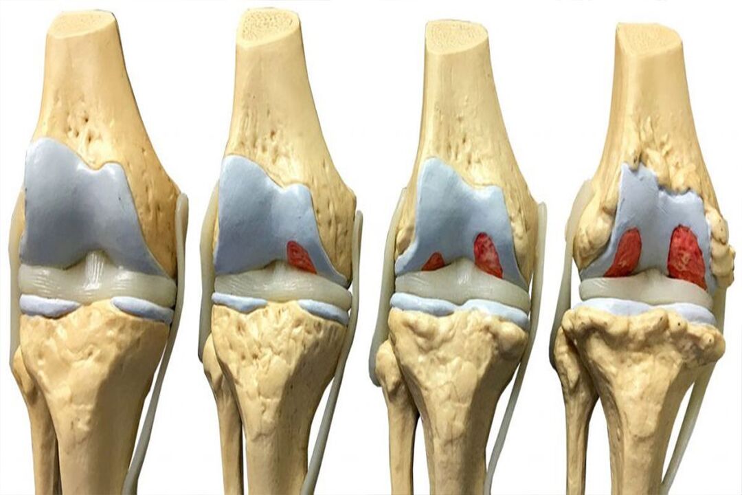 arthrosis ဖွံ့ဖြိုးတိုးတက်မှုအဆင့်ဆင့်