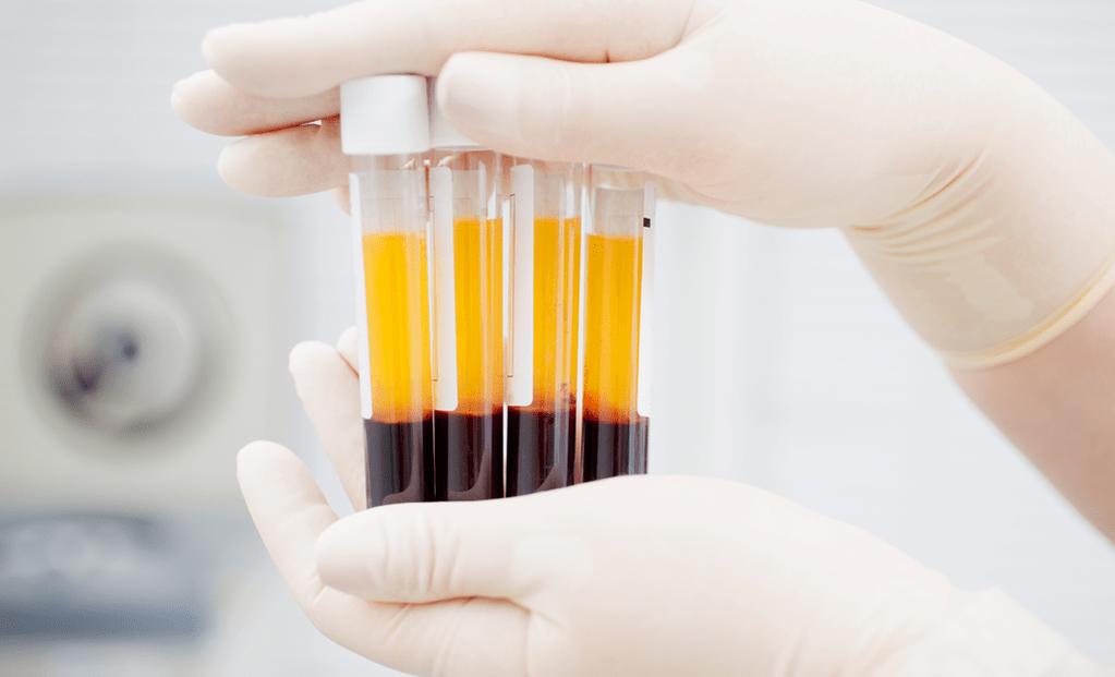arthrosis အတွက် PRP ကုထုံးအတွက် Platelet ကြွယ်ဝသောပလာစမာ