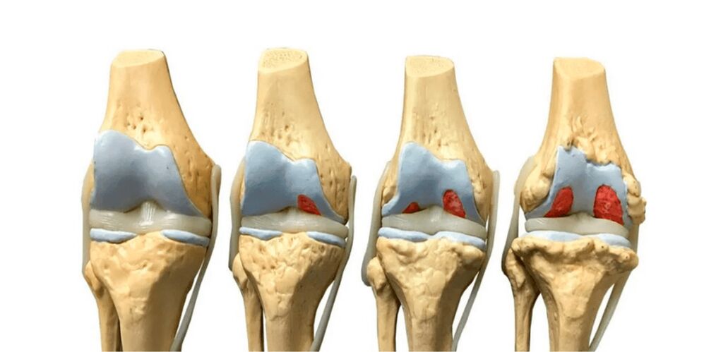 အဆစ်များ၏ arthrosis ၏ဒီဂရီ